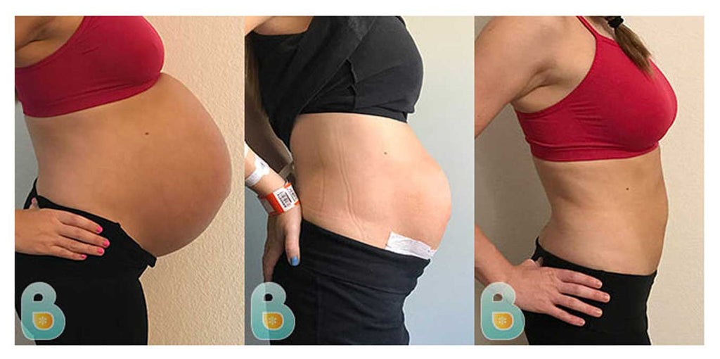 Bellefit Postpartum Girdle Corset, C-Section Recovery Belt