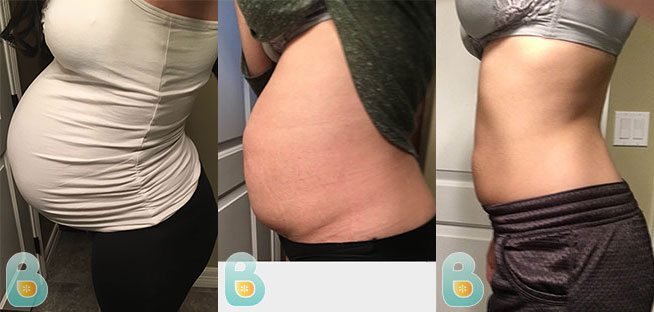 Before And After Postpartum Girdle