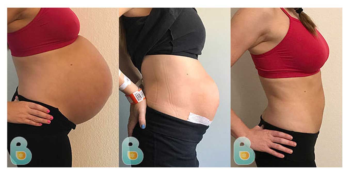 3 in 1 After Pregnancy & C Section Recovery Belly Support Body