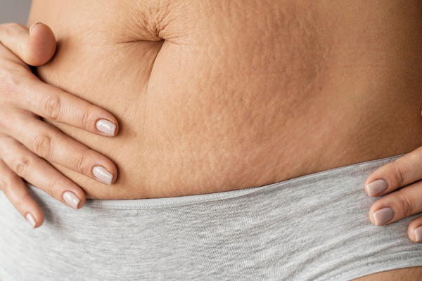 Understanding and Managing Stretch Marks